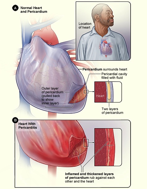 pericarditis, Florida Cardiology, P.A